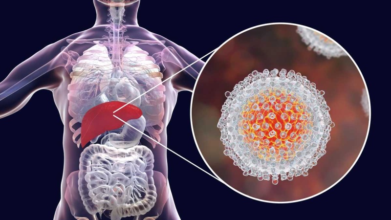 Hepatitis aguda infantil: preocupación mundial. La situación en nuestro país