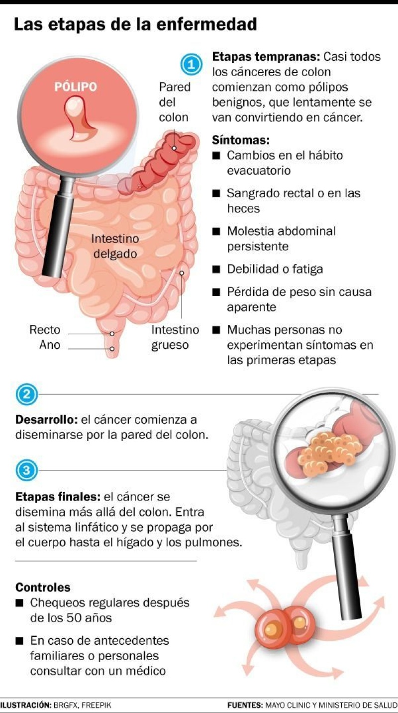 Cáncer de colon: una droga experimental logró una remisión total