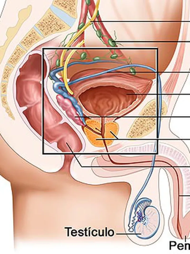 Es una neoplasia o tumor que compromete una glándula reproductiva en hombres que se localiza por debajo de la vejiga y por encima del recto