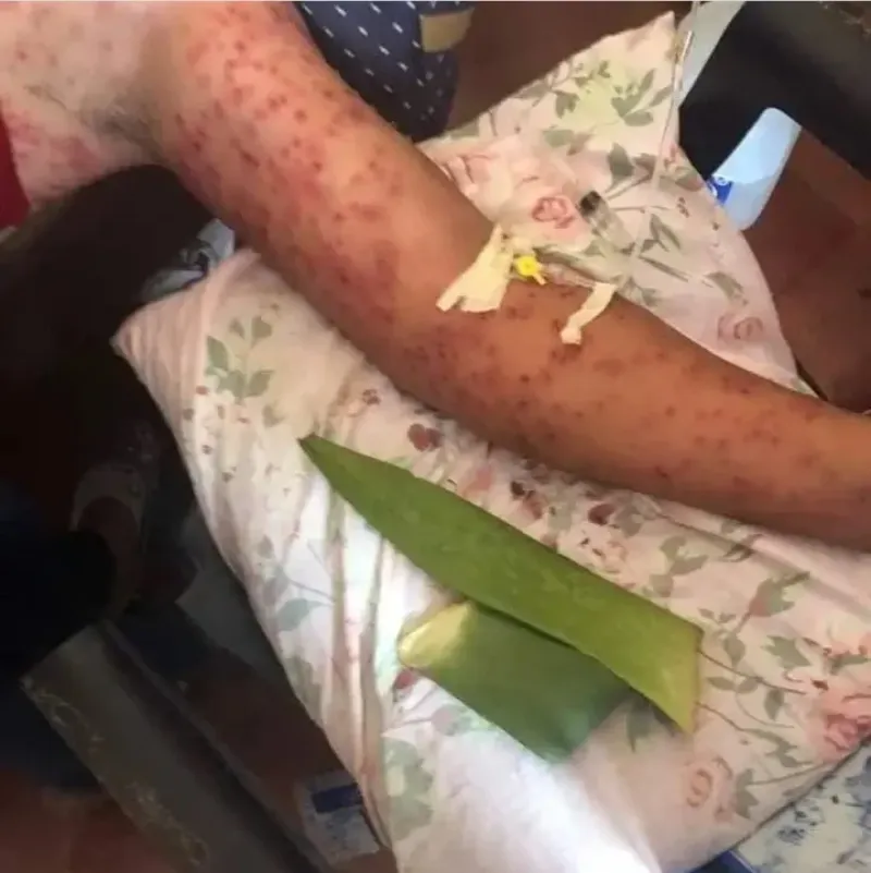 El brazo de uno des pasajeros. Cientos de picaduras