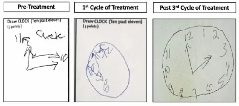 Dibujar un reloj es una forma habitual de evaluar el deterioro cognitivo. Estos relojes, dibujados por April, muestran lo mucho que la estaba ayudando el régimen de tratamiento 