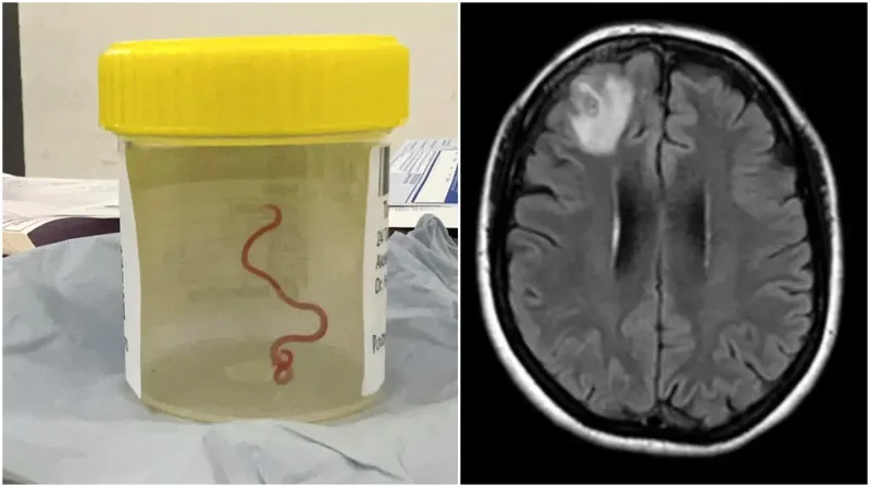 Así es el gusano que extrajeron del cerebro de la mujer